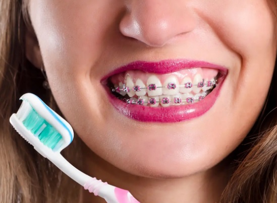 Jak zapobiegać odkładaniu się płytki nazębnej przy aparacie ortodontycznym?
